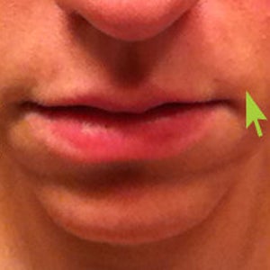 Swelling Above Lip After Juvederm in Nasolabial Fold Is This