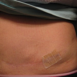Visible scar tissue hard lump after inner thigh lipo 2 months ago