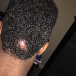 I Have A Keloid On The Back Of My Head I Ve Been Getting The Steroid Shot For A Year And I Just Want To Have Surgery Photo