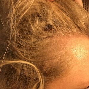 Scalp biopsy for female hair loss