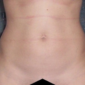 https www.realself.com question lipo-b12-injections-stomach-week Any Advise on Correcting my Stomach After Lipo?