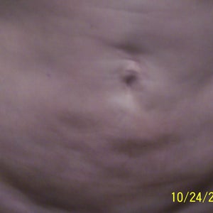 https www.realself.com question lipo-b12-injections-stomach-week Options for bad lipo and cortisone atrophy repair? (Photo) Everything You Need to Know
