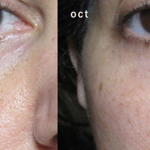 Dark circles under the eyes Causes and treatments