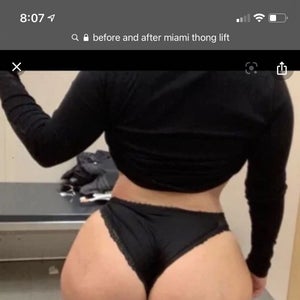 Would it be possible to get a Miami thong lift and BBL at the same time?  (Photos)