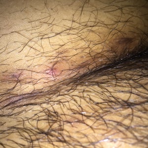 Ingrown hairs on any part of the body - including the pubic area, base of t...