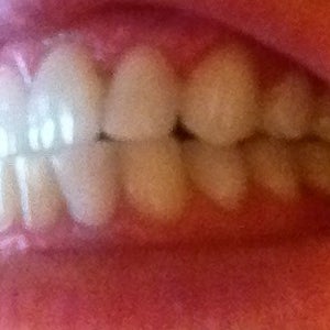 End To End Bite Teeth