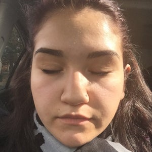 What Are These Lines On My Cheeks And How Do I Get Rid Of Or Lessen Them Photo