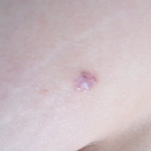 Featured image of post Easiest Way to Make Mole Punch Biopsy Scar