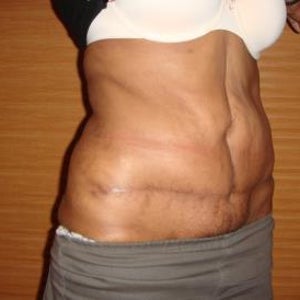 Is It Safe To Have A Fleur De Lis Abdominoplasty After Poor Results With Previous Lipo And Ftt