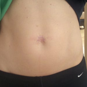 surgically removed belly button