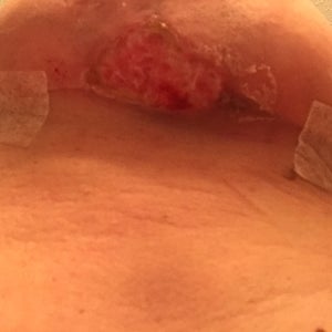 I have developed an open sore under my left breast that continues to open  at the scar line? (Photo)