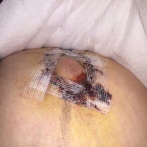 Beginning Of Nipple Necrosis Photos