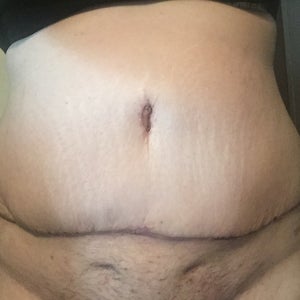 What happened to my mons pubis? (photos)