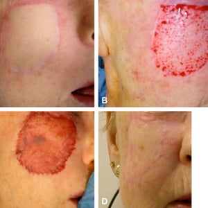 Can A Skin Graft Use To Treat Deep Acne Scars Photo