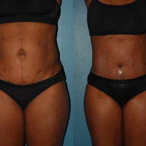 Real Tummy Tuck Result Case #223