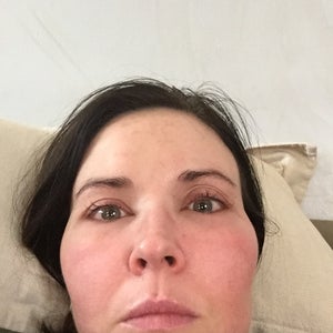 Is Swelling After An Ipl Facial Normal Photo
