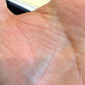 What S The Problem When A Vein In Palm Get Swollen Since 6 Months I Can Feel It Pulsing Every Now And Then Photos