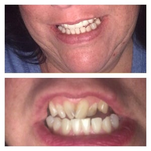 All On 4 Dental Implants Reviews Was It Worth It Realself Page 7