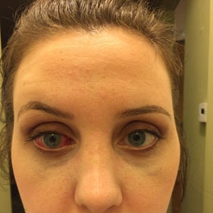 Strabismus Surgery Reviews Was It Worth It Realself Strabismus Surgery Reviews Was It Worth It Realself