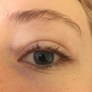 Why am I losing eyelashes only on the upper eyelids, one eye at a time? (Photos)