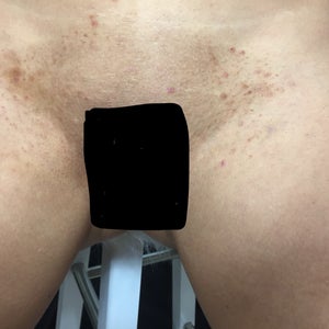 How Can I Treat Ingrown Scars In My Bikini Area Around My Vagina Photos