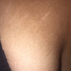 Is There An Effective Treatment That Will Get Rid Of Old White Stretch Marks On Breast Photos