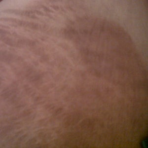 chemical peel for stretch marks near me