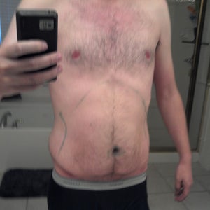 Doc Claims Rib Cage and Pelvis Grew Larger Due to Previous Obesity. Is This  Possible? (photo)