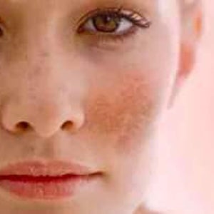 is glutathione good for melasma The Truth About Glutathione: Skin Brightening, Dual Tone Correction, and  Melasma Treatment