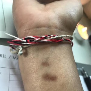 cigarette burn healing stages Cigarette burns