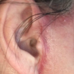 MACS lift scars after surgery very red and hot. Is this normal