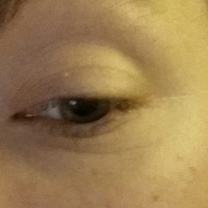 wrinkles around eyes in 20s