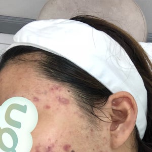 iud and accutane