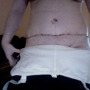 When Can I Wear Jeans After a Tummy Tuck? (photo)