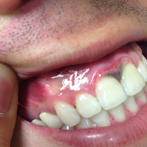 Grey And Black Gums After Professional Teeth Whitening Photo