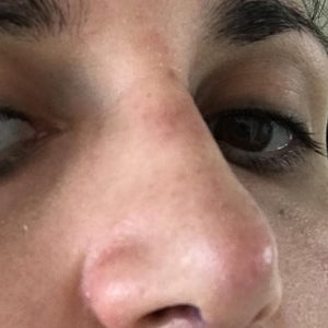Bruise discoloration redness on nasal bridge Please help I don t