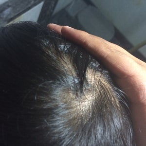 I am a 17 year old male and I have been suffering from Male Pattern  Baldness. Am I taking the wrong medicine? (photo)