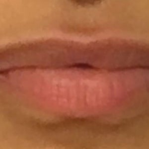 Lip shape changing - can dissolving fix this? (Photo)