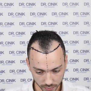 Head Quarters Hair Transplants Reviews  Read Customer Service Reviews of  hqhairtransplants.com