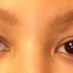 genetic under eye creases