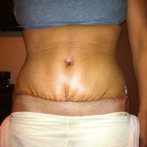 Tummy Tuck Surgery: Let's Talk about Scarring - Signature Plastic