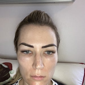 prp for dark circles