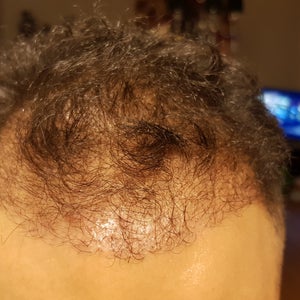 Smoking and hair transplantation result: Can I smoke after 3 months after a hair  transplant. (Photos)