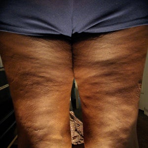 severe cellulite