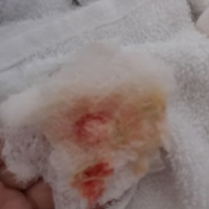 5 weeks post-op. Will this heal with wet to dry dressing as my surgeon  recommends? (photo)