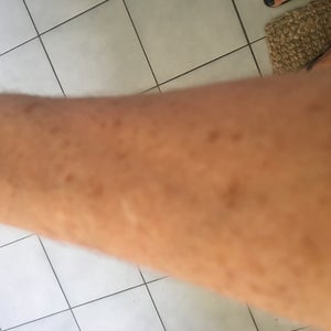 Removal Of Age Spots Sun Spots On Hands Arms And Legs Photo