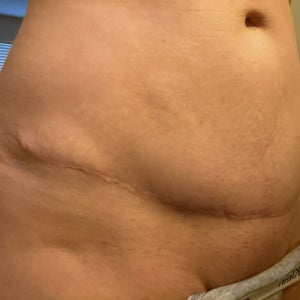 Variety of Tummy Tuck Scars - Ali Sajjadian, MD