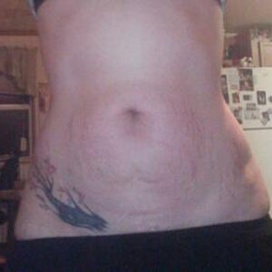 ClearLase Tattoo Removal  6 sessions progress on this stomach tattoo  redness from numbing cream  Professional laser tattoo removal in Kelham  Island Sheffield  Facebook