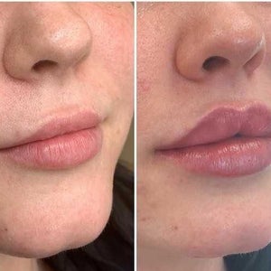 Results After 1ml Juvederm In Upper Lip Only Will 1 More Syringe Be Enough To Achieve The Aesthetic I Want Photo