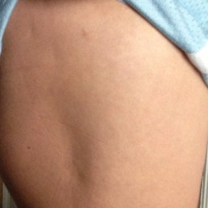 It Is Possible To Build Muscle On My Outer Thigh To Diminish The Dent Without Having Fat Grafting Photo